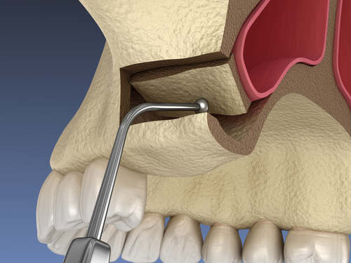 Sinus lift surgery